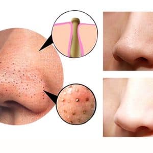 4 in 1 Body Guasha Cupping Blackhead Remover Machine Facial Pore Deep Cleansing Beauty Skin Care